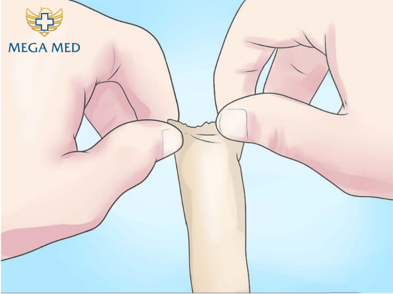 Phương pháp tự lột bao quy đầu tại nhà